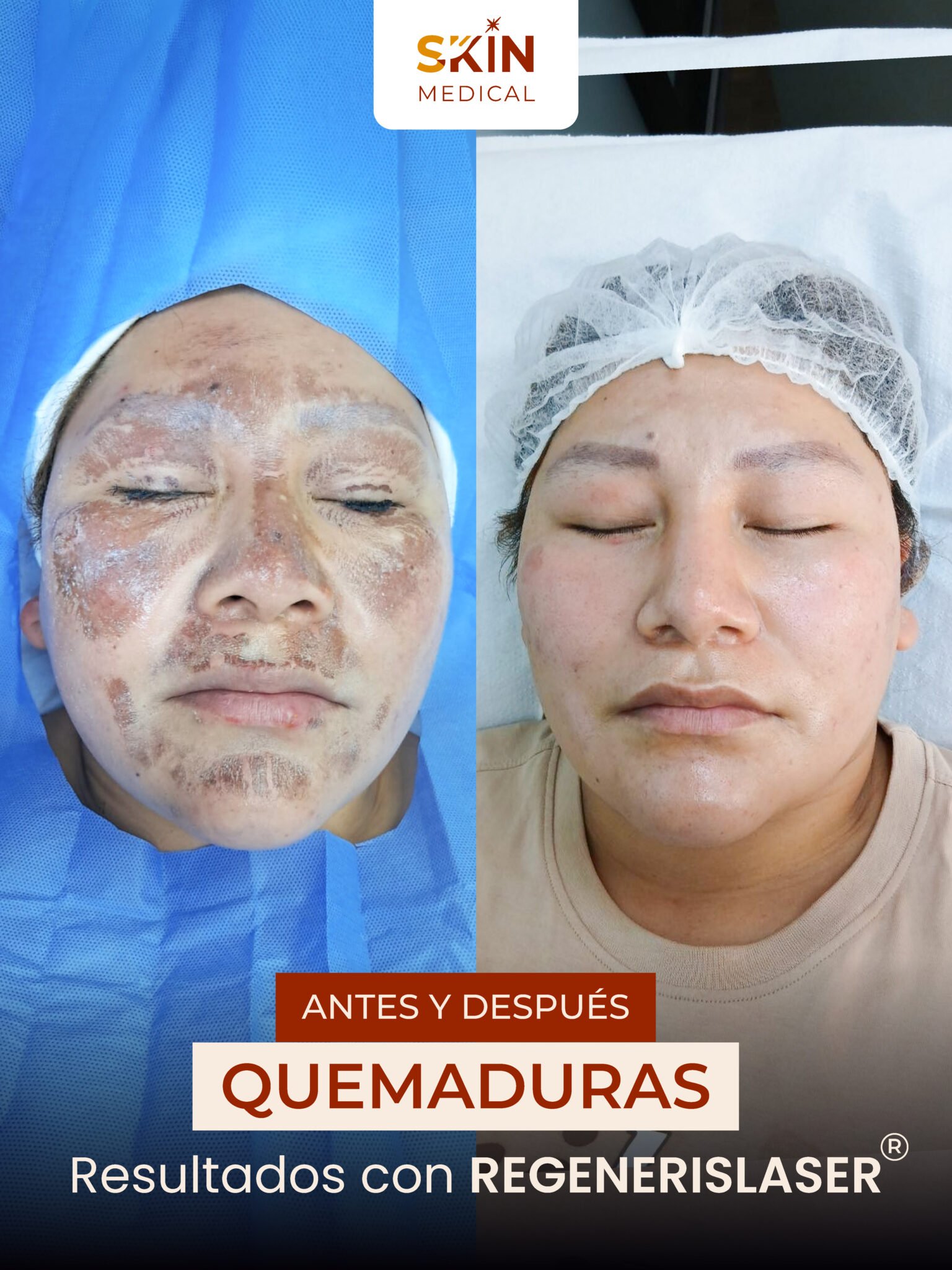 Segundo caso de quemadura antes y después