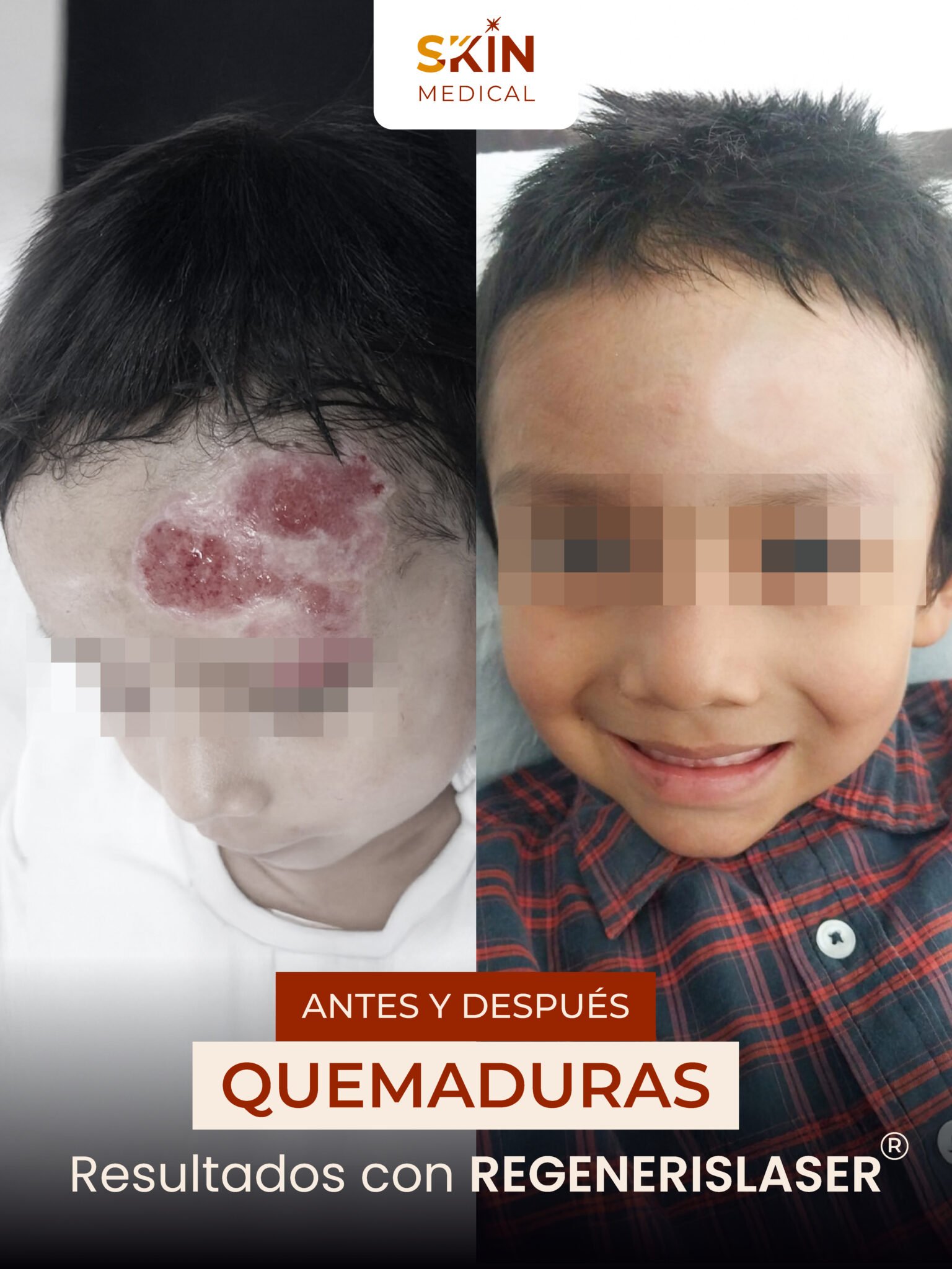 Primer caso de quemadura antes y después