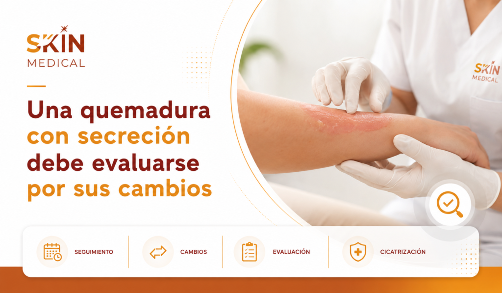 Una quemadura con secreción debe evaluarse por sus cambios