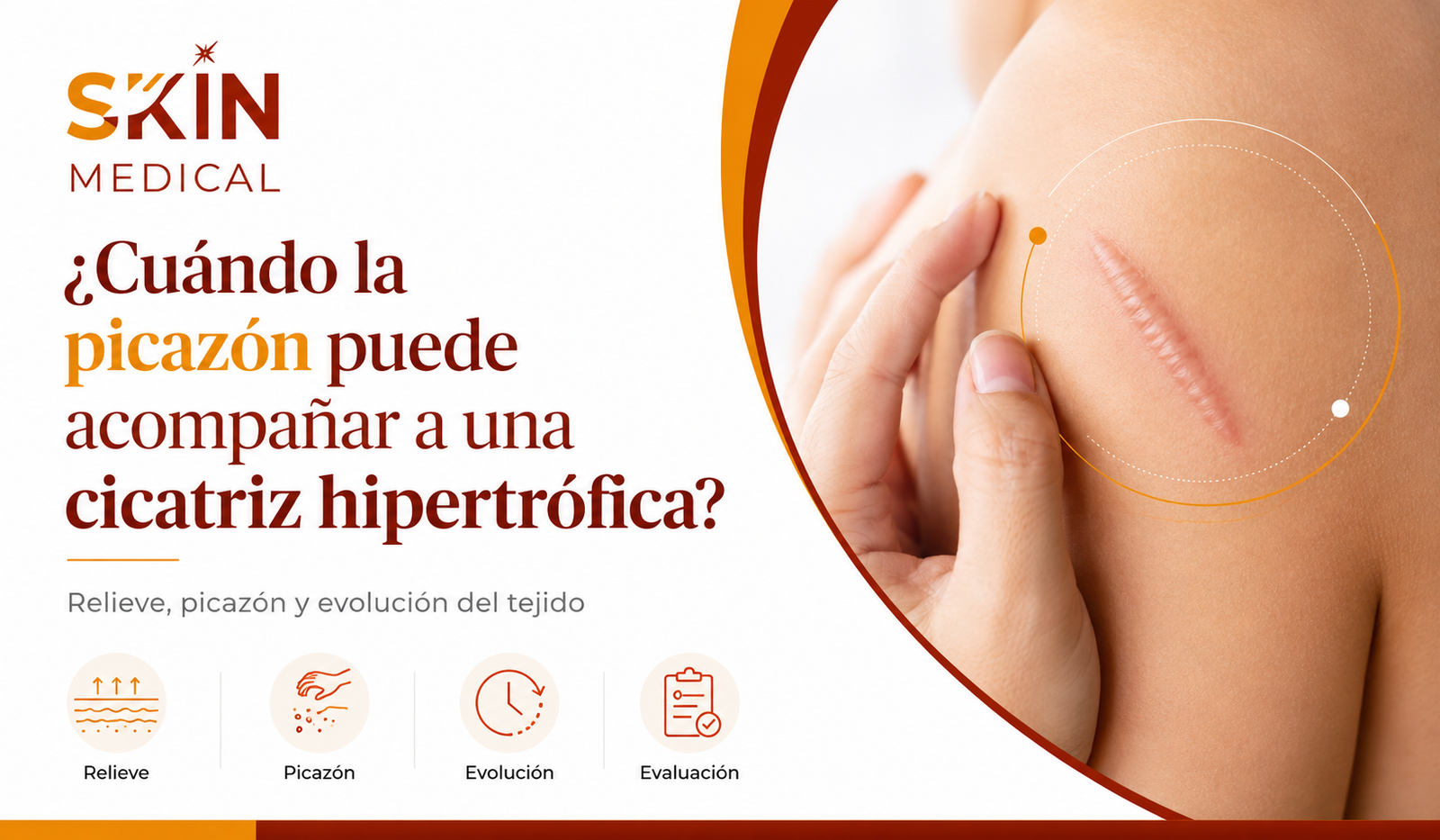 ¿Cuándo la picazón puede acompañar a una cicatriz hipertrófica?