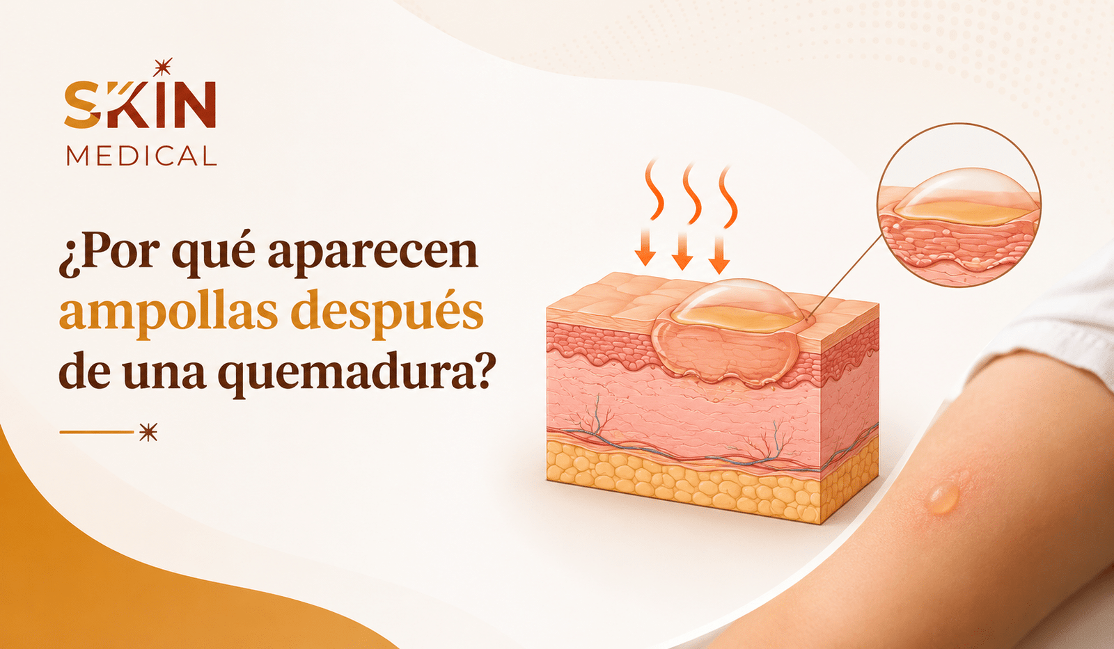 ¿Por qué aparecen ampollas después de una quemadura?