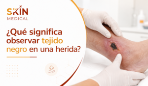 ¿Qué significa observar tejido negro en una herida?