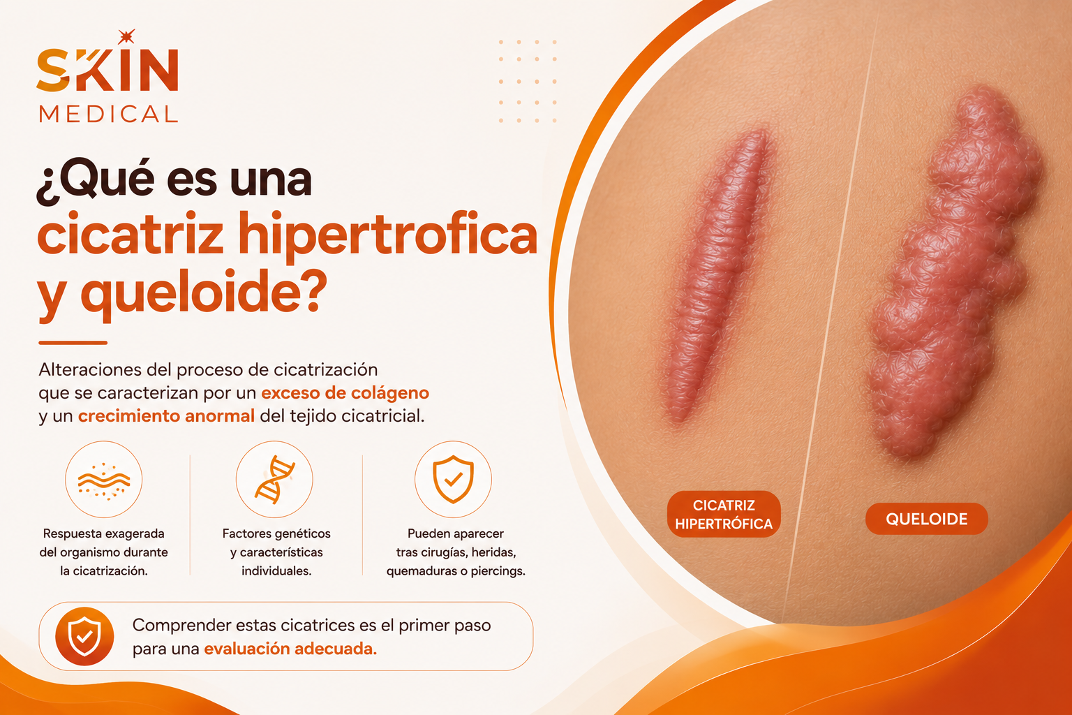 ¿Qué es una cicatriz hipertrofica y queloide?​