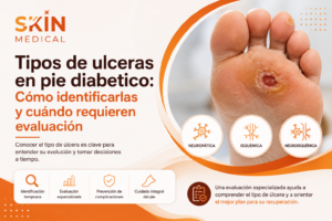 Tipos de ulceras en pie diabetico: Cómo identificarlas y cuándo requieren evaluación