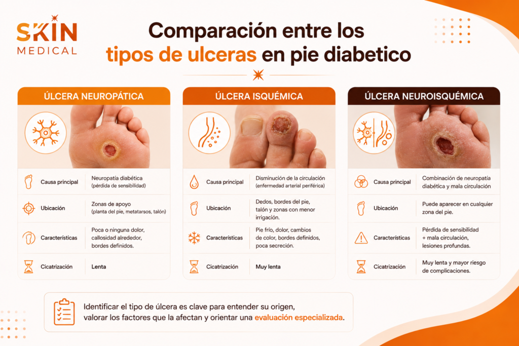Comparación entre los tipos de ulceras en pie diabetico