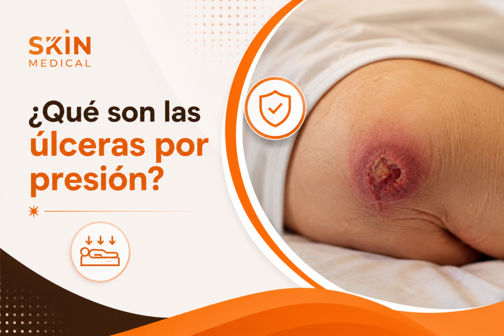 ¿Qué son las úlceras por presión?