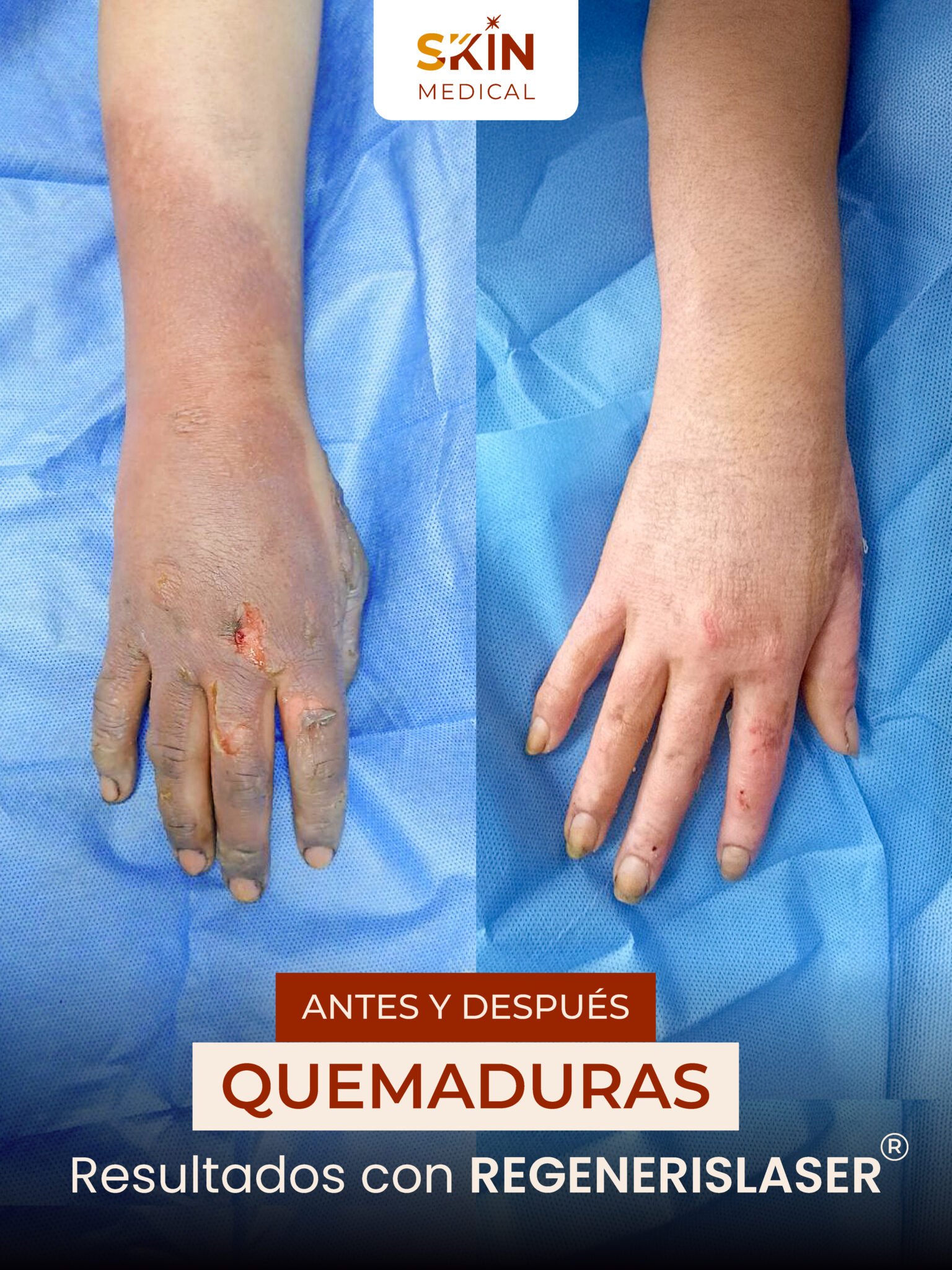 Tercer caso de quemadura antes y después