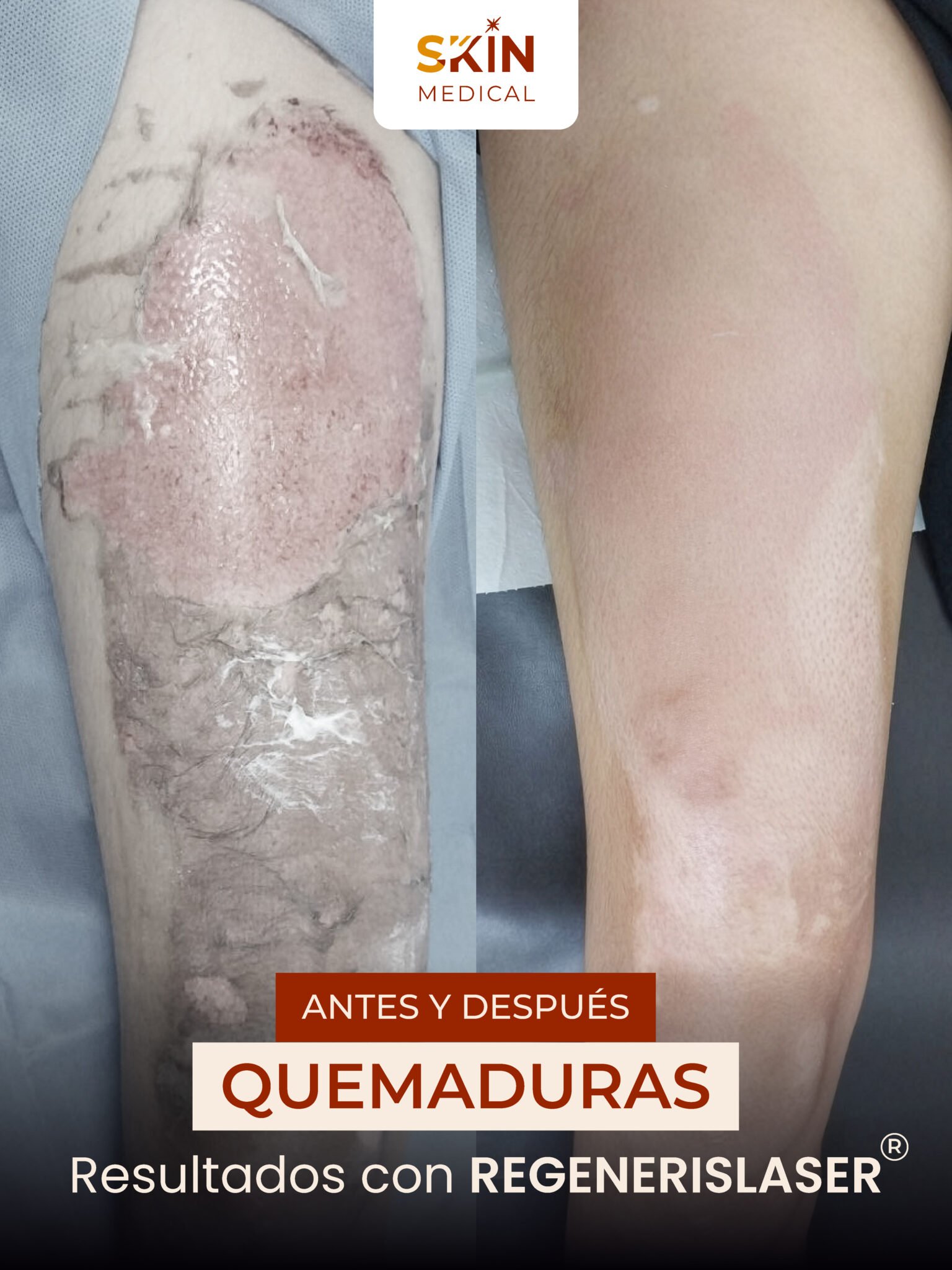 Tercer caso de quemadura antes y después