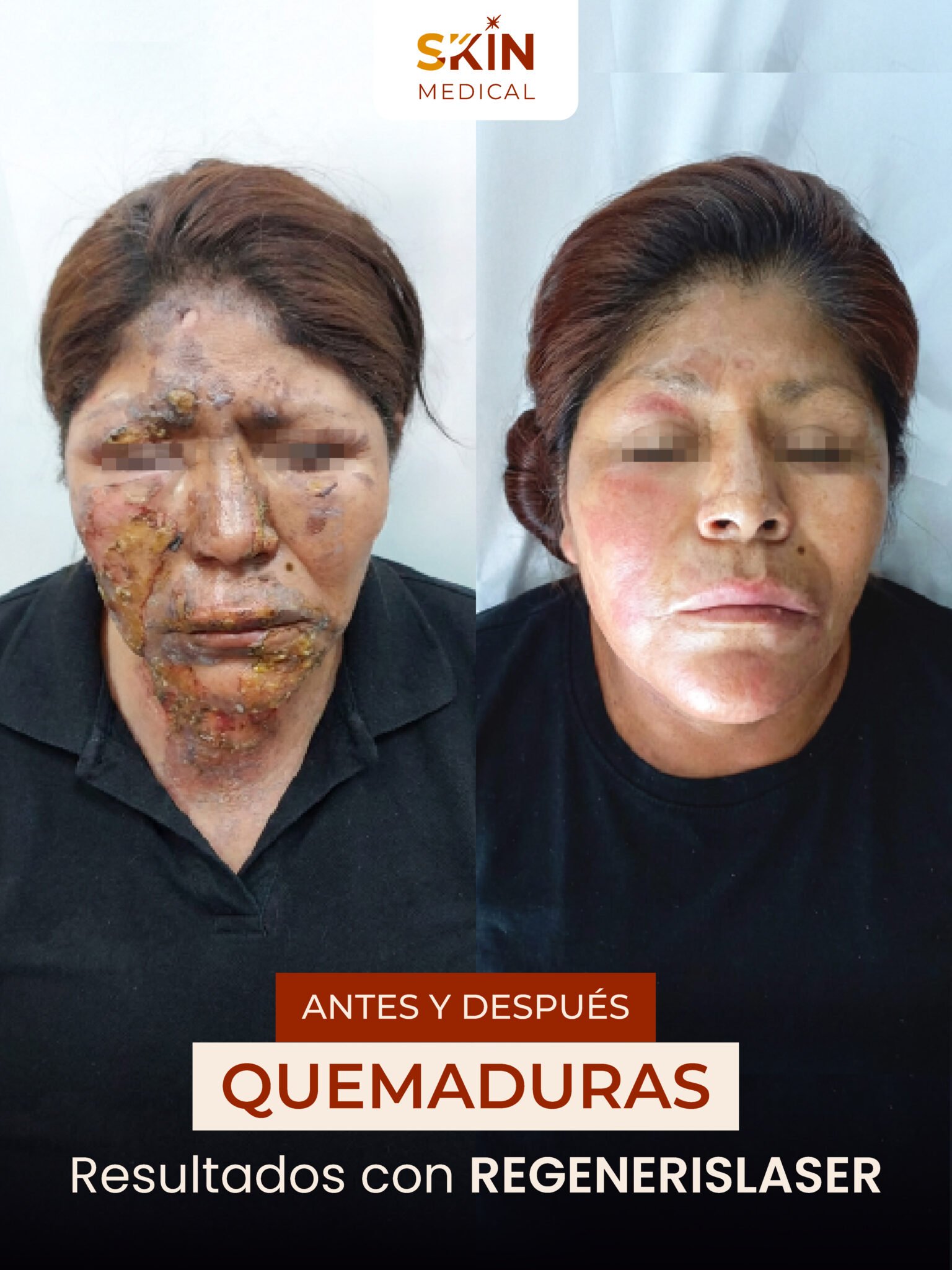 Segundo caso de quemadura antes y después