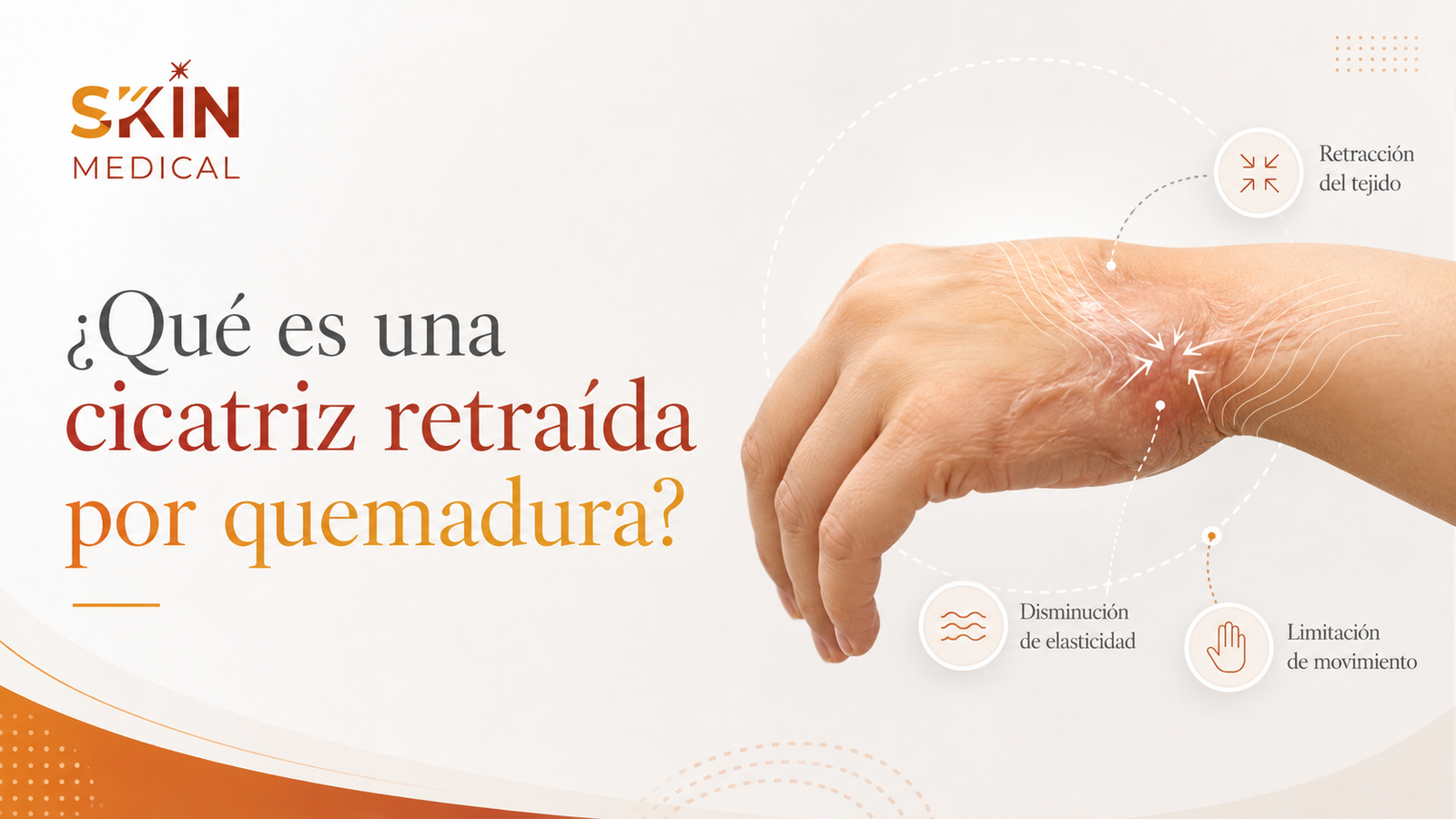 ¿Qué es una cicatriz retraída por quemadura?