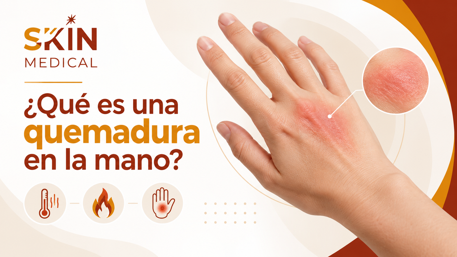 ¿Qué es una quemadura en la mano?