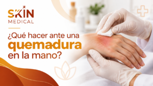 ¿Qué hacer ante una quemadura en la mano?
