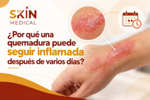 ¿Por qué una quemadura puede seguir inflamada después de varios días?