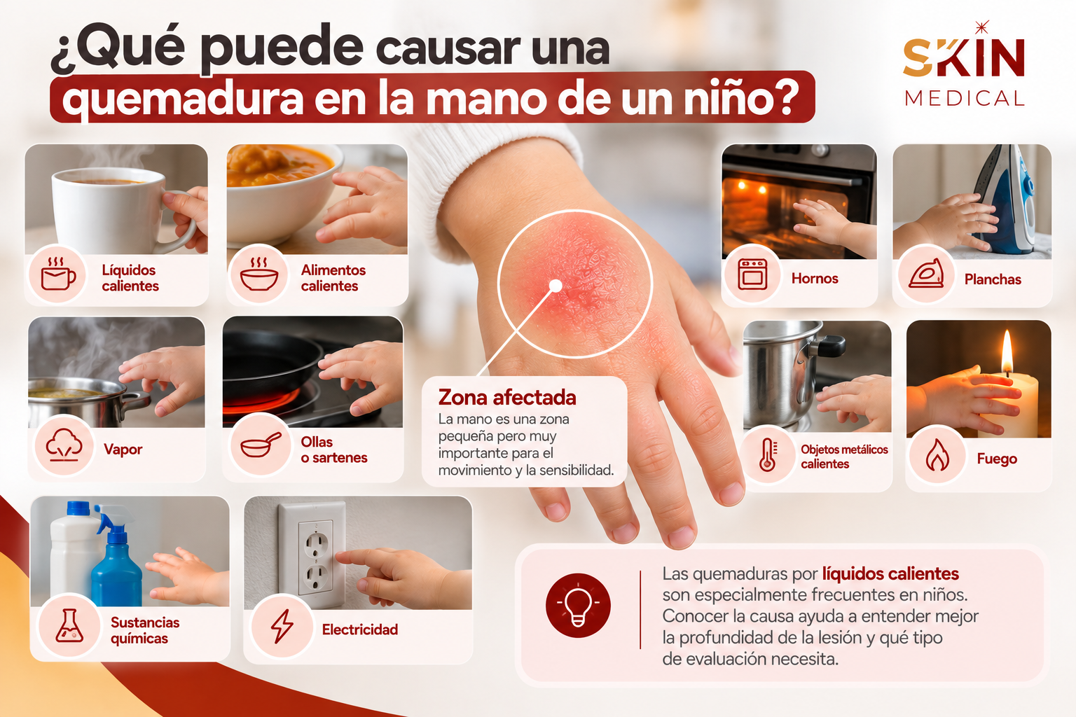 ¿Qué puede causar una quemadura en la mano de un niño?
