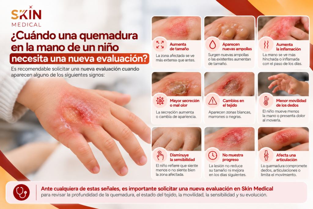¿Cuándo una quemadura en la mano de un niño necesita una nueva evaluación?