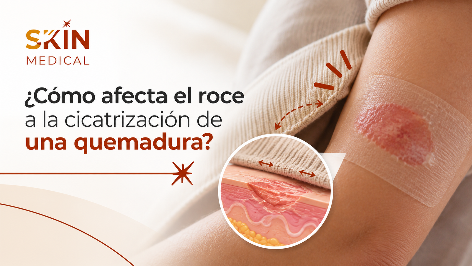 ¿Cómo afecta el roce a la cicatrización de una quemadura?