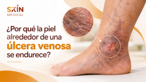 ¿Por qué la piel alrededor de una úlcera venosa se endurece?