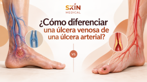 ¿Cómo diferenciar una úlcera venosa de una úlcera arterial?