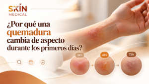 ¿Por qué una quemadura cambia de aspecto durante los primeros días?