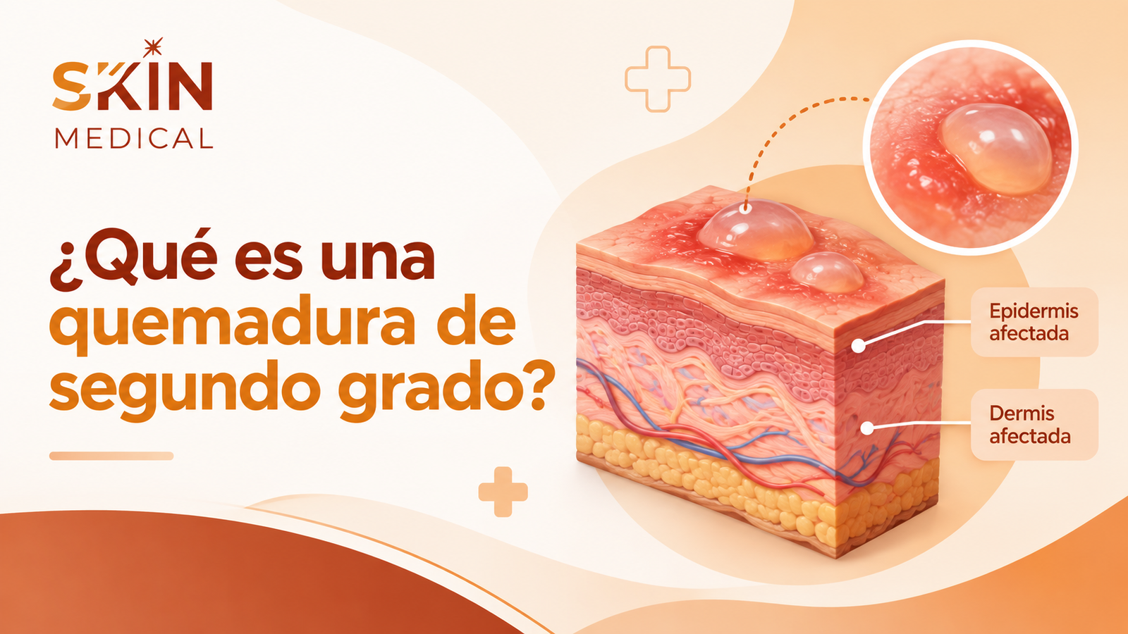 ¿Qué es una quemadura de segundo grado?