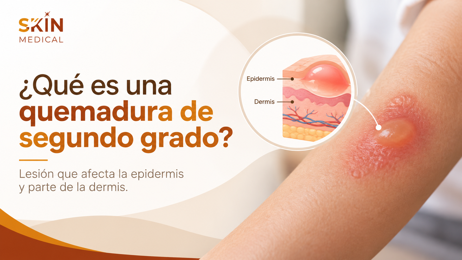 ¿Qué es una quemadura de segundo grado?