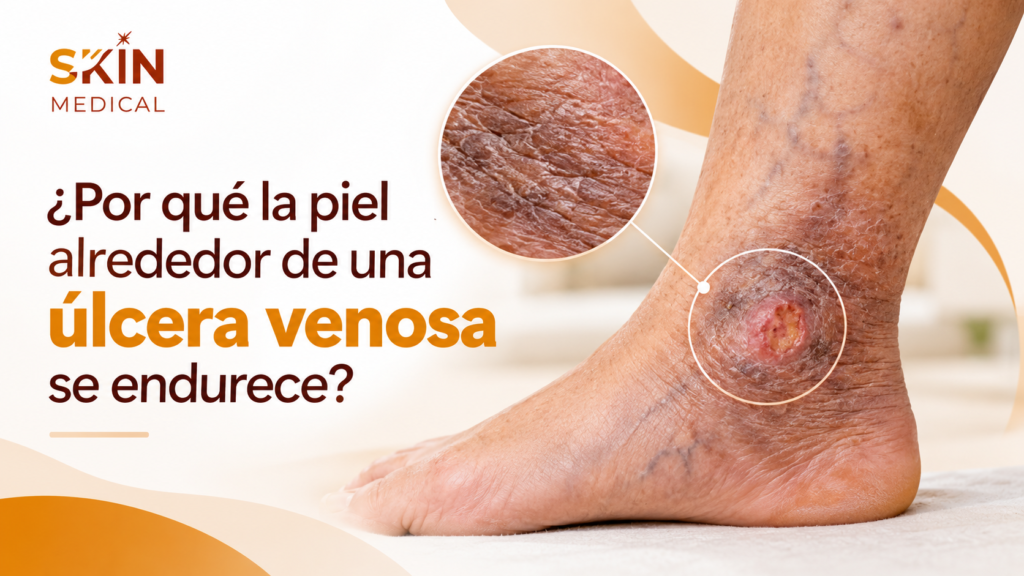 ¿Por qué la piel alrededor de una úlcera venosa se endurece?