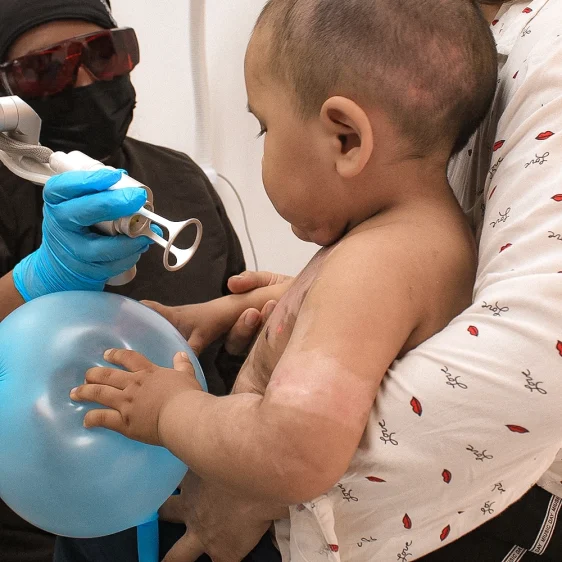 Niño con cicatrices de quemaduras en el brazo recibe terapia låser, sostenido por un adulto y asistido médicamente.