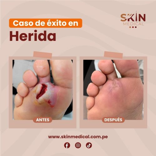 Casos de exito de herida 0