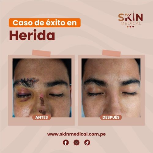 Casos de exito de herida 1-2