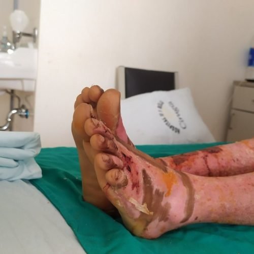 primeros auxilios quemadura Lima Skin Medical