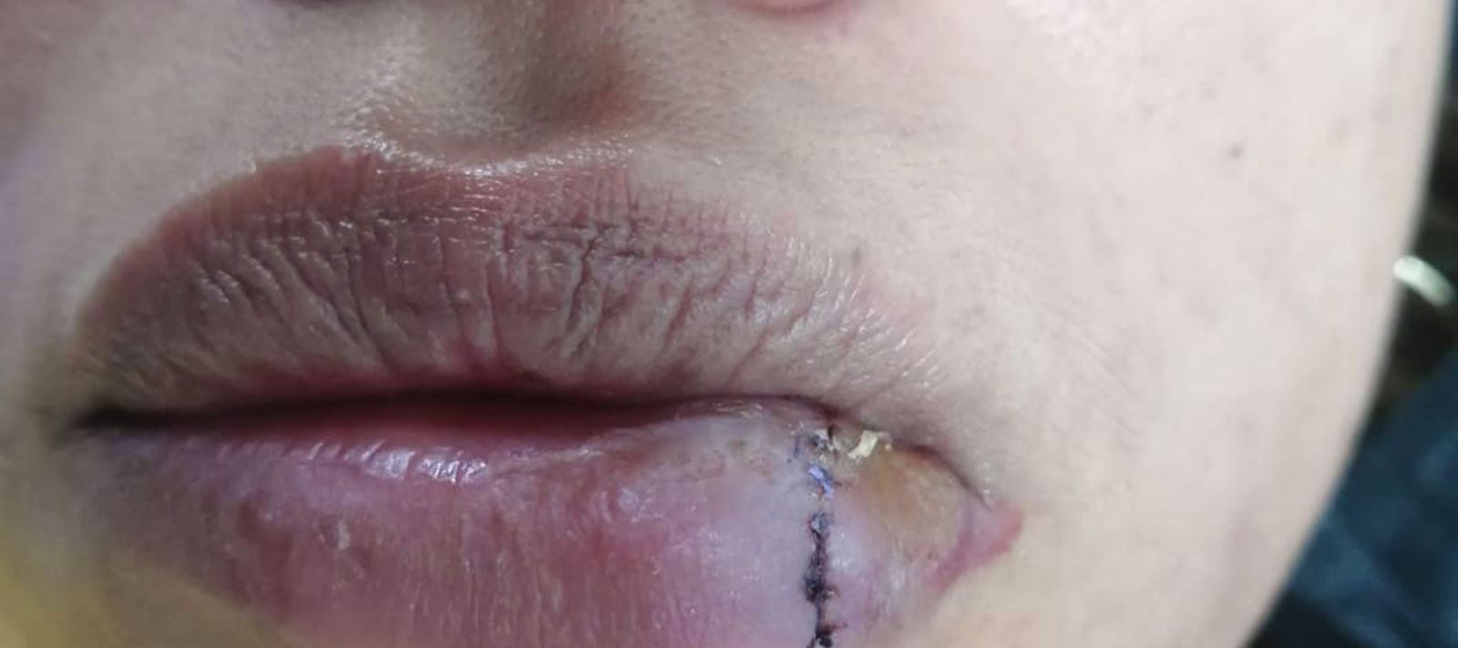 Herida suturada en labio inferior, antes de tratamiento láser de cicatrices y regeneración cutánea SkinMedical