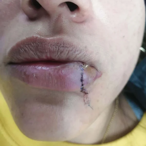 Labio inferior con suturas y signos de inflamación, en proceso de cicatrización tras lesión.