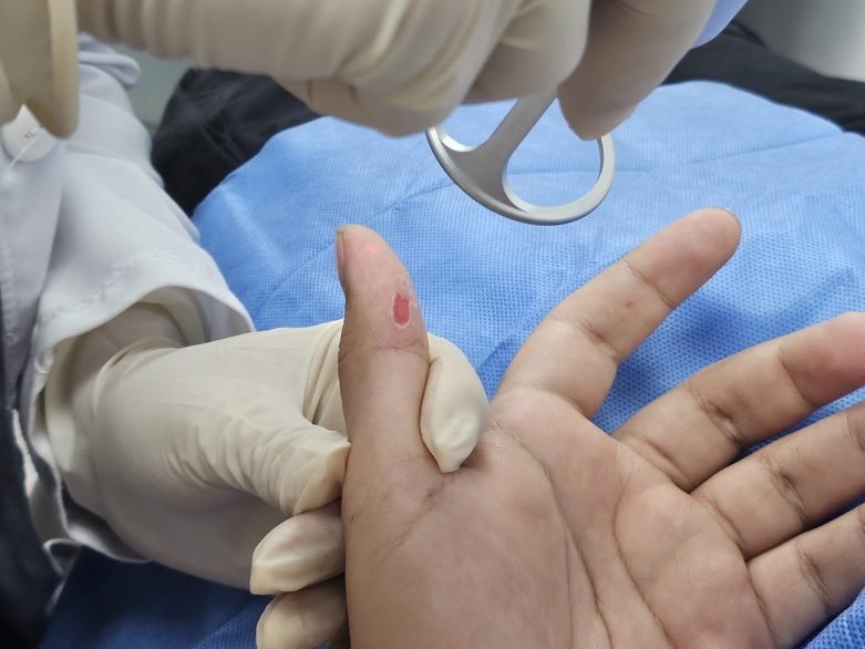 Especialista tratando quemadura en pulgar con láser en centro médico.