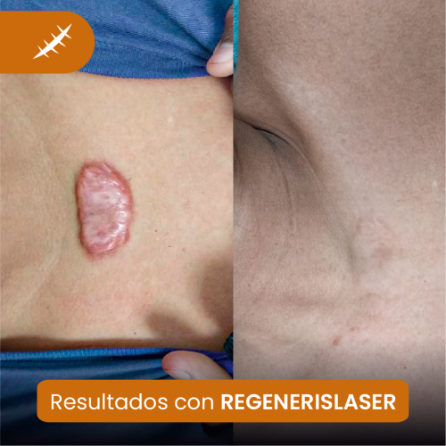 Resultados de tratamiento láser en queloides con especialistas en cicatrices en Lima