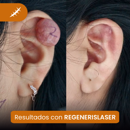 Resultados de tratamiento láser en queloides con especialistas en cicatrices en Lima