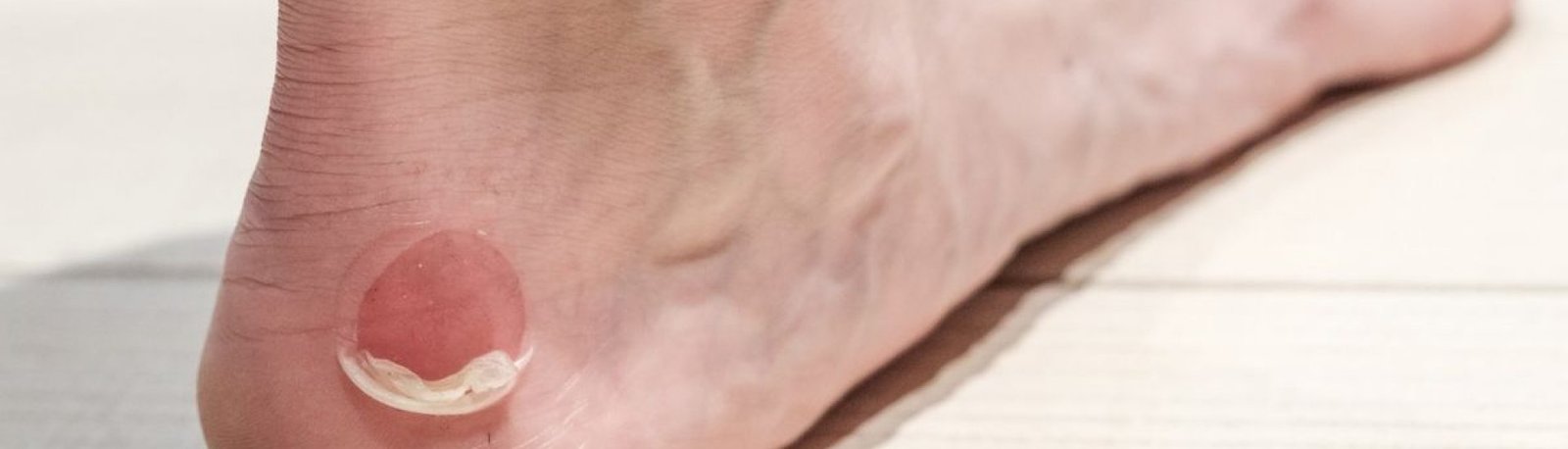 ampolla de quemadura