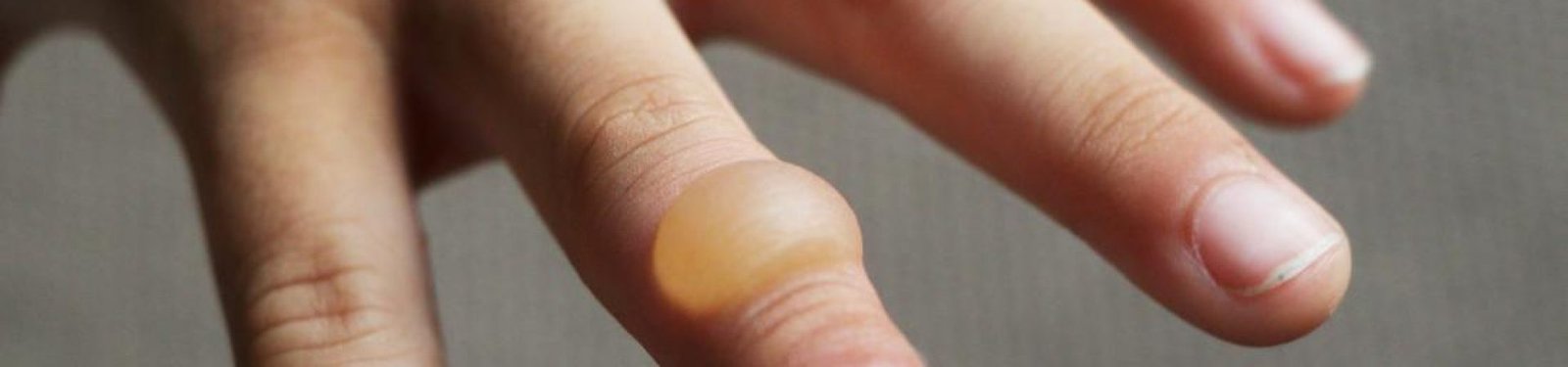 Mano con una ampolla grande por quemadura en el dedo anular.
