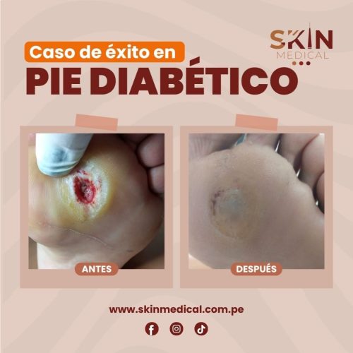 casos exitosos de pie diabetico