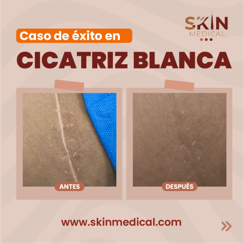 tratamiento de cicatrices, clínica de cicatrices, cicatriz hipertrófica, tratamiento para cicatriz, cicatrices queloides, tratamiento para cicatriz