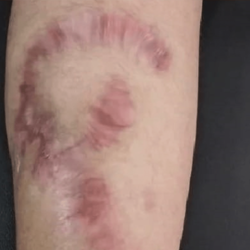 cicatriz queloide tratamiento