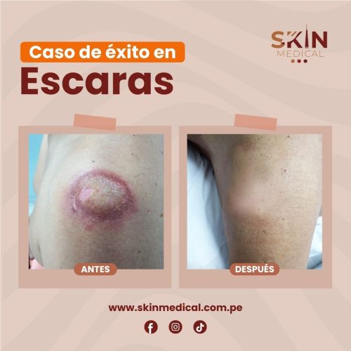 escaras: antes y despues