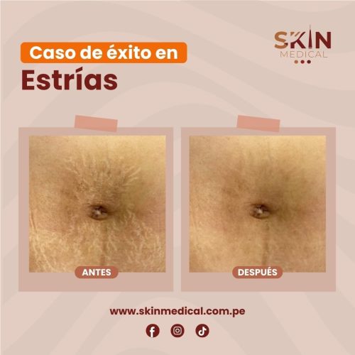 estrias exito 1