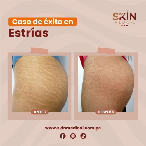 estrias exito 2