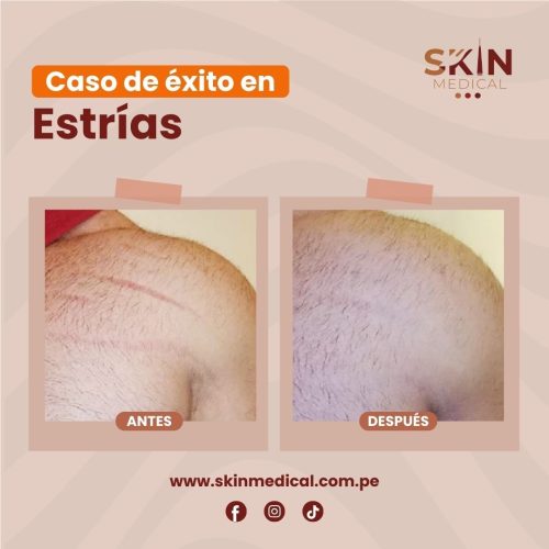 estrias exito 3