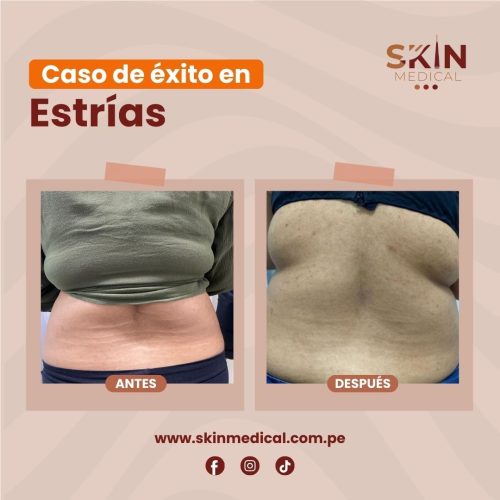 estrias exito 4