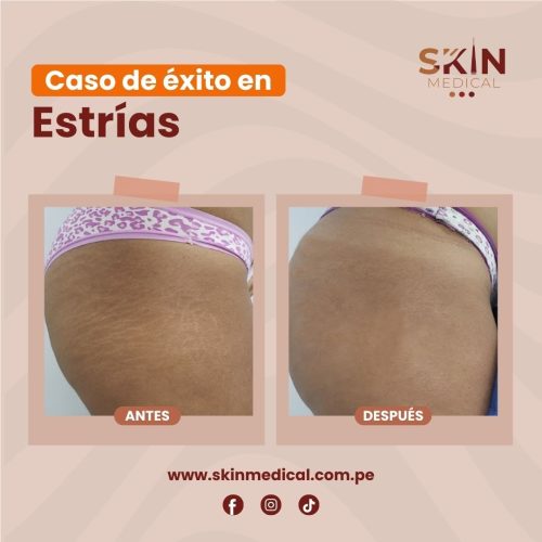 estrias exito 6