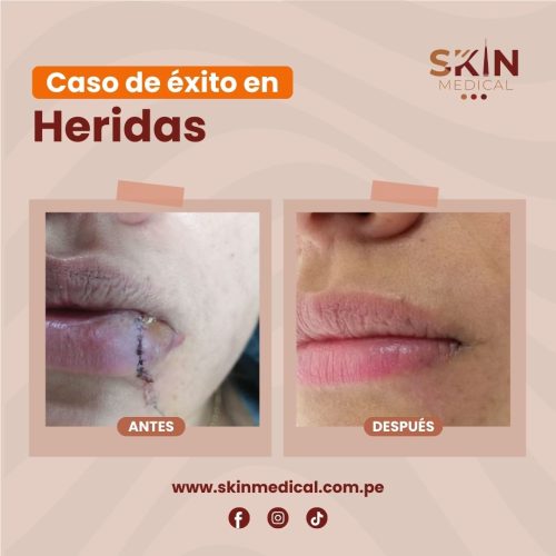 heridas abierta