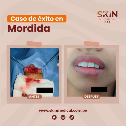 mordedura humana tratamiento