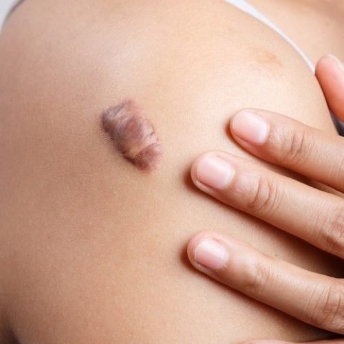 Crecimiento excesivo