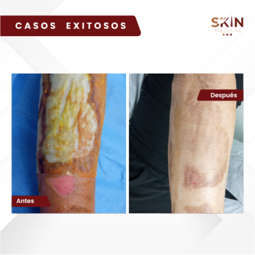 quemaduras-skinmedical-antes-despues-18-03-2024-2